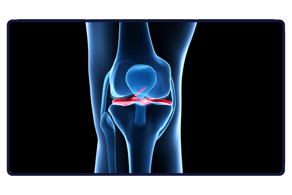 Dr Saulo - Ortopedista - Reconstrução de Ligamentos